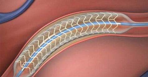 stent.jpg